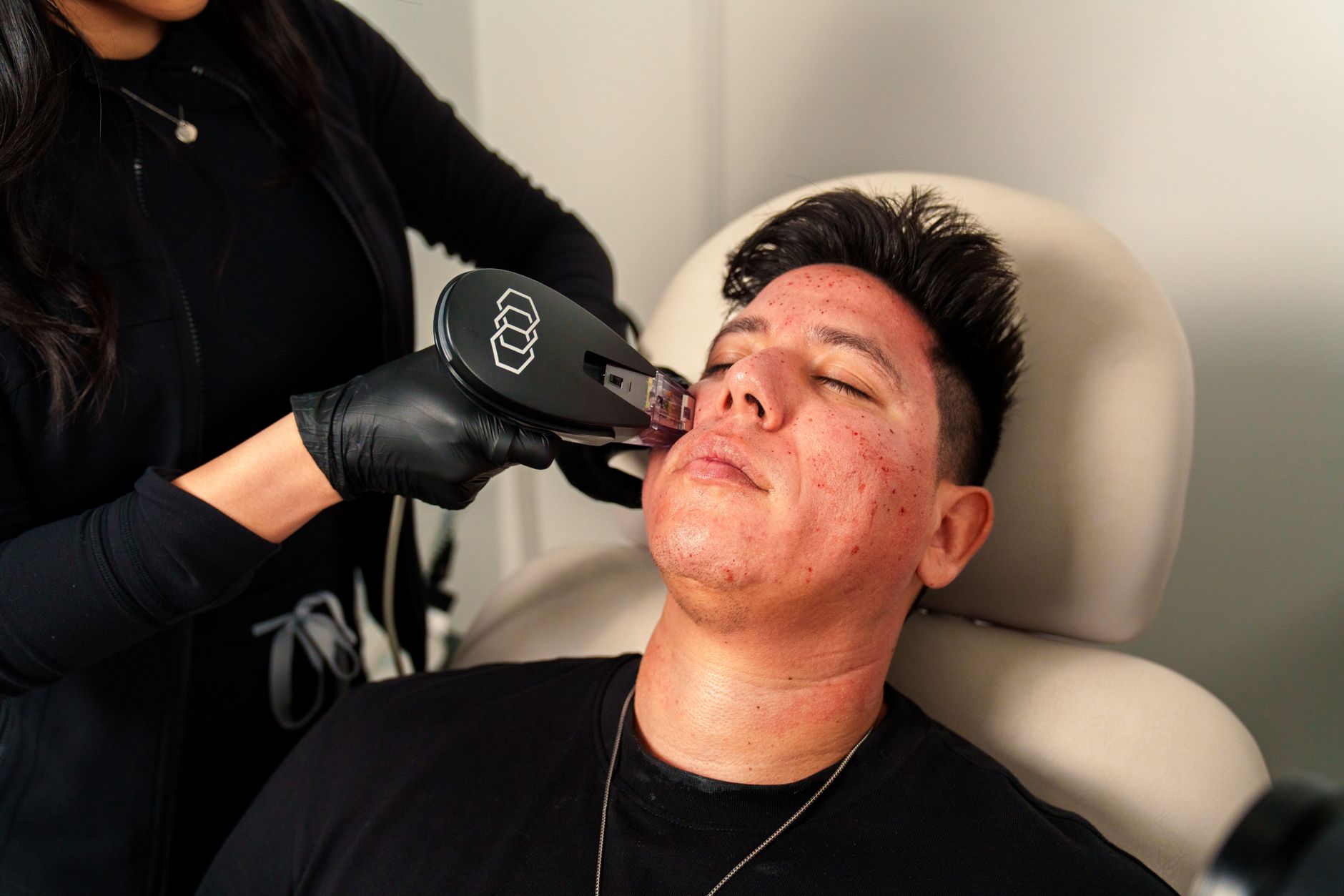 Advanced Aesthetic Procedures: Microneedling — Man receives morpheus8 facial treatment in santa ana med spa for skincare rejuvenation.